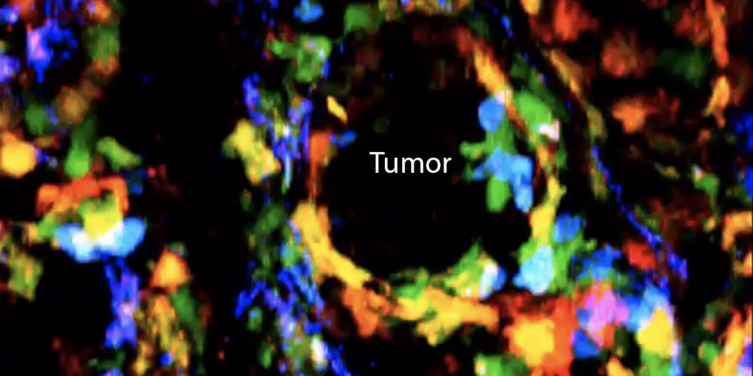 Understanding Tumor Immunity